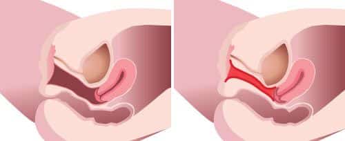 effects of vaginal rejuvenation