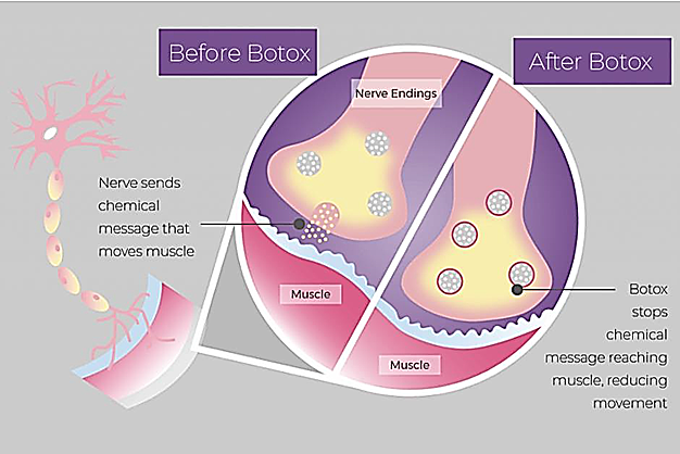 botox injection