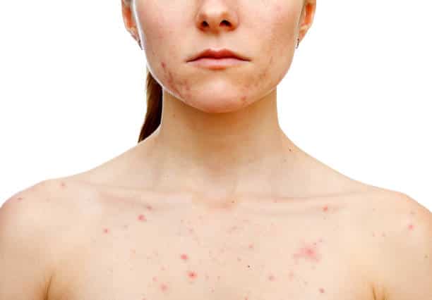areas affected by rosacea