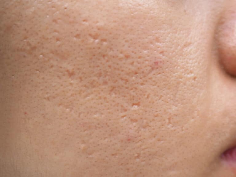fillers for acne scars