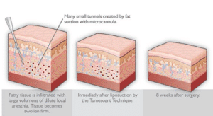 liposuction