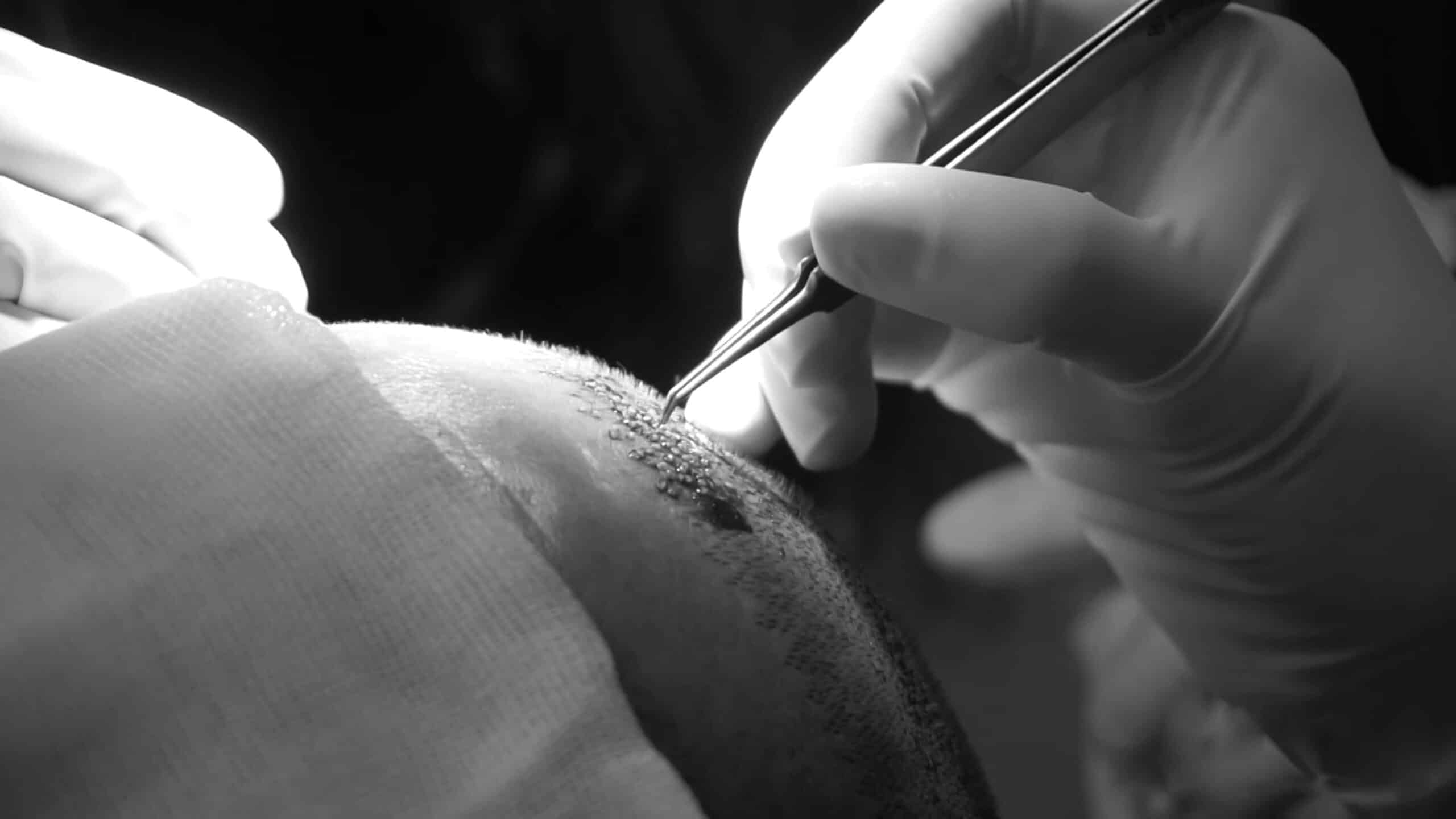 FUE Hair Transplant