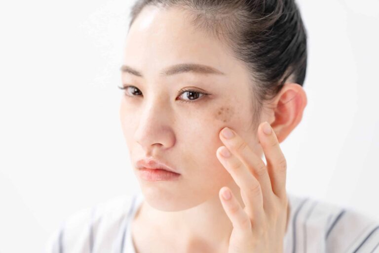 Why Your Laser Treatment For Pigmentation May Not Be Working
