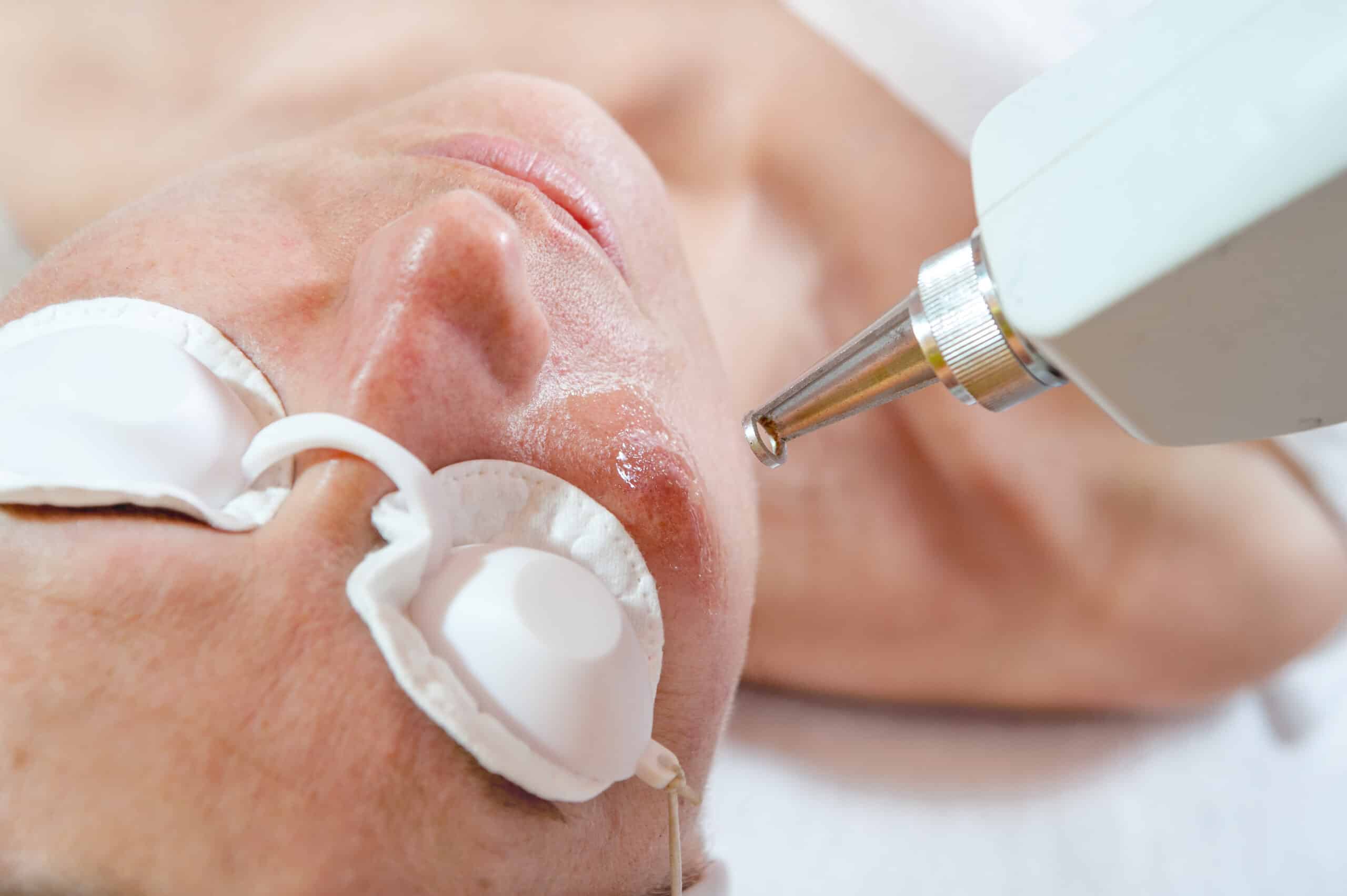 laser skin treatment / Woman undergoing laser skin treatment
