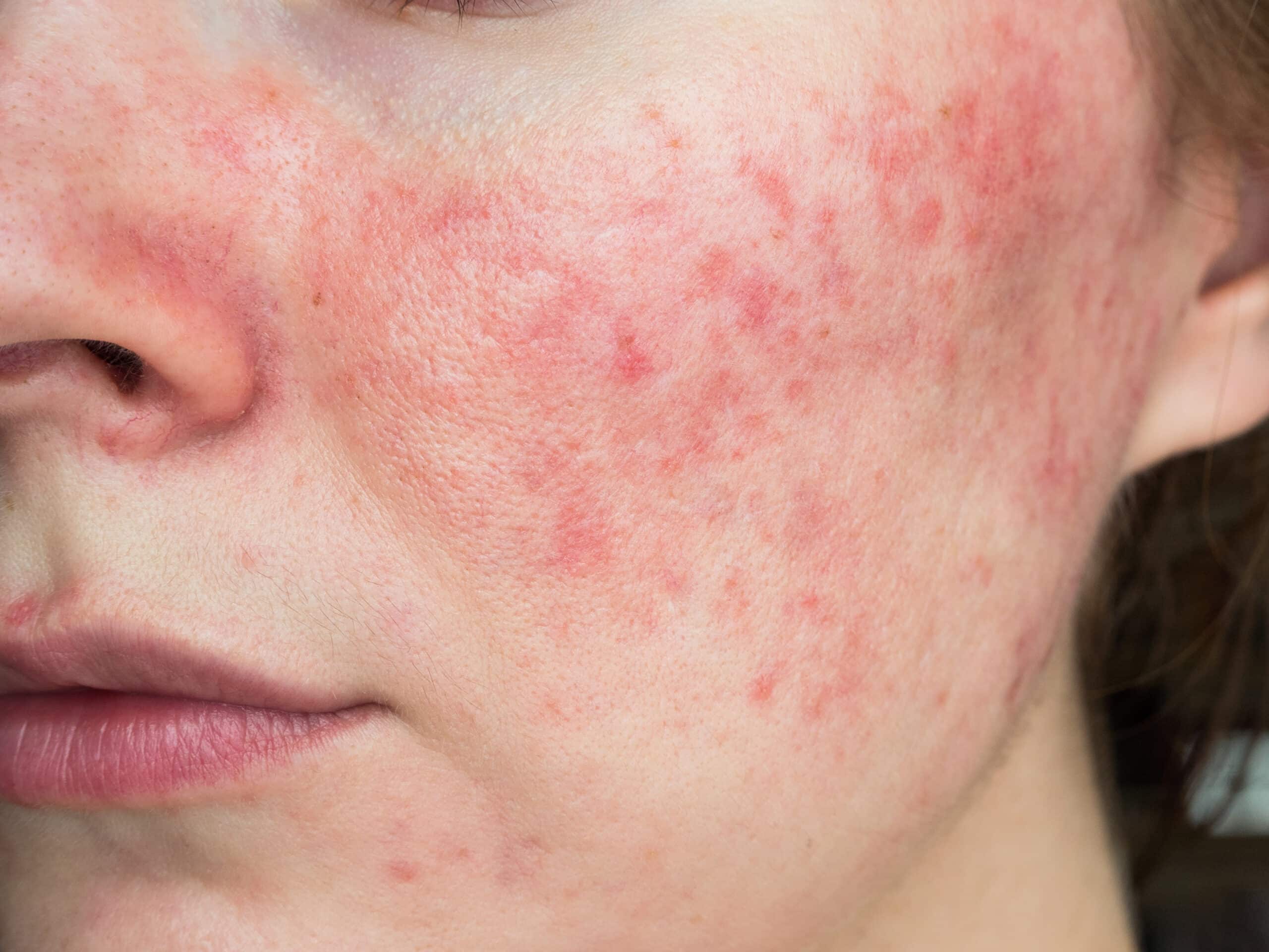 Rosacea Singapore