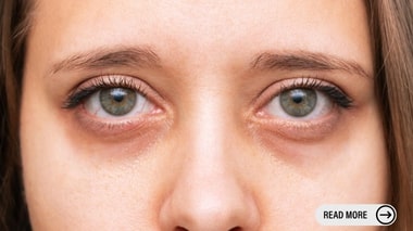 How to Remove Eyebags Without Surgery in Singapore