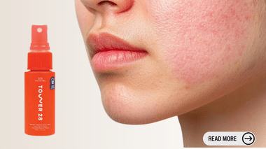 Hypochlorous Acid for Skin Issues