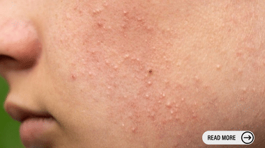 Face With Fungal Acne Symptoms Including Small Red Bumps in the Cheeks